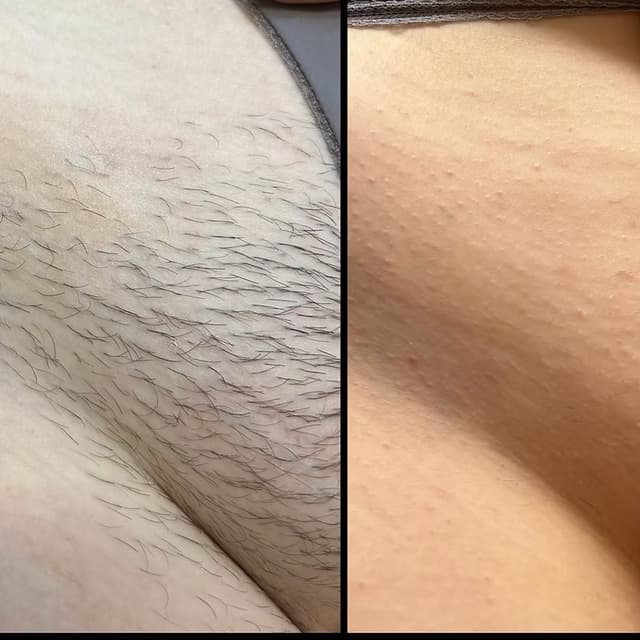 Brazilian Laser 5 session at Blessed & Bare Laser Studio in New York, NY