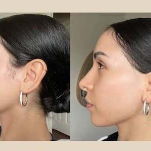 Sideburns Laser - 5 sessions at Blessed & Bare Laser Studio in New York, NY