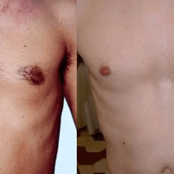 Areola Laser - 5 session at Blessed & Bare Laser Studio in New York, NY
