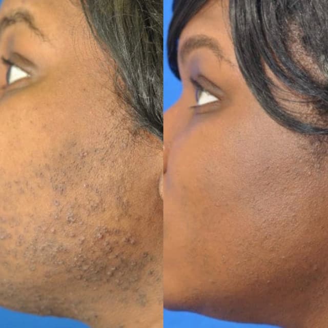 Half Face & Neck Laser - 5 sessions at Blessed & Bare Laser Studio in New York, NY