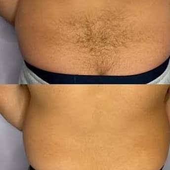 Lower Back Laser - 5 sessions at Blessed & Bare Laser Studio in New York, NY