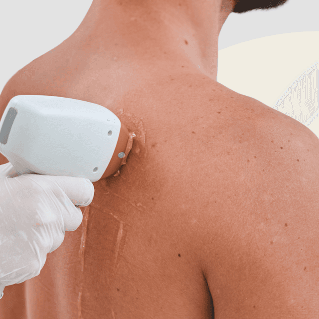 Shoulders Laser - 5 sessions at Blessed & Bare Laser Studio in New York, NY
