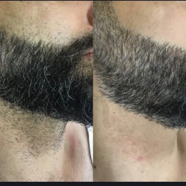 Beard/ Neck Laser - 5 sessions at Blessed & Bare Laser Studio in New York, NY
