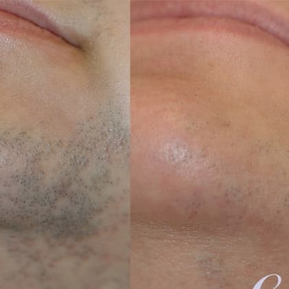 Chin Laser Hair Removal Package at Blessed & Bare Laser Studio in New York, NY