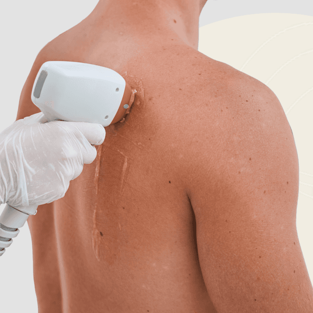 Full Back Laser - 5 sessions at Blessed & Bare Laser Studio in New York, NY