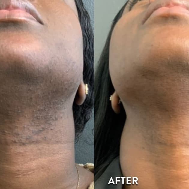 Neck Laser - 5 sessions at Blessed & Bare Laser Studio in New York, NY