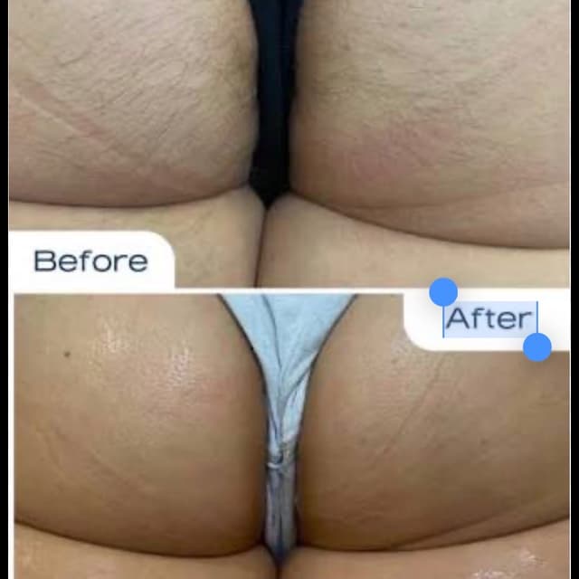 Buttocks Laser - 5 sessions at Blessed & Bare Laser Studio in New York, NY